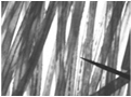 Alopecia, Transplante Moderno, Cirug&iacute;a De Restauraci&oacute;n Del Cabello, 